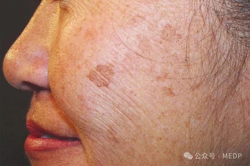 老年斑、晒斑、日光性雀斑是一回事吗？